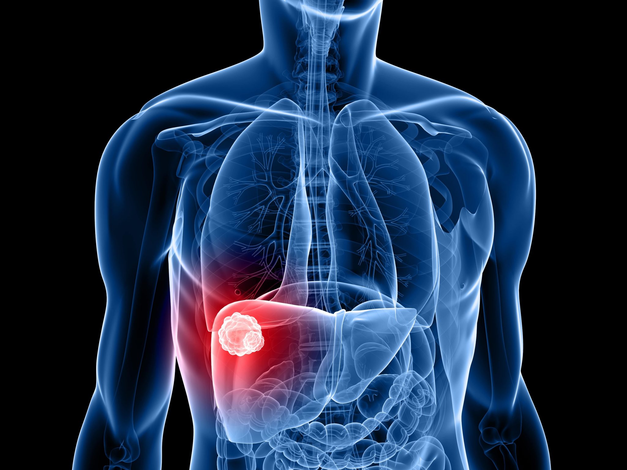 Pancreatic Cancer Image